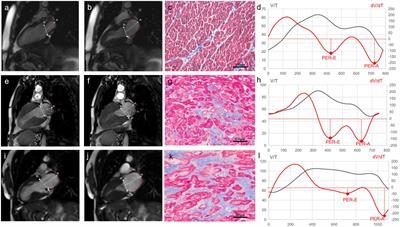 Sex differences in atrial remodeling and its relationship with myocardial fibrosis in hypertrophic obstructive cardiomyopathy